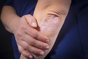 Der Ellenbogen ist eine Stelle die häufig von Psoriasis befallen ist.