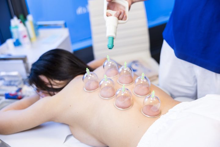 Schröpfen ist eine Technik der TCM